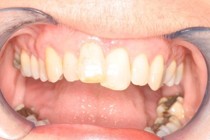 Before